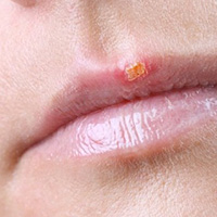 HERPES INFECTION