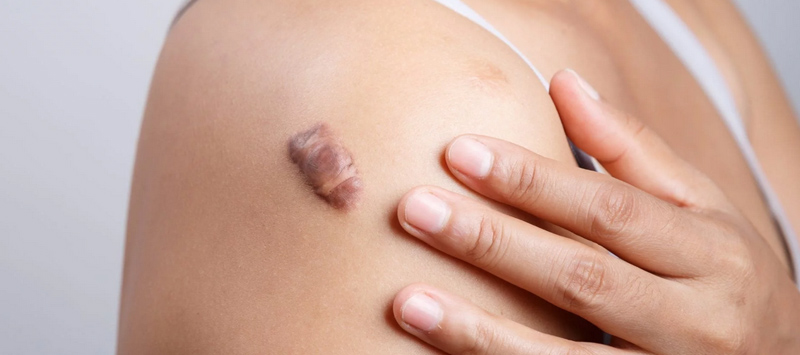 Keloid Treatment