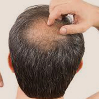 HAIR-LOSS TREATMENTS