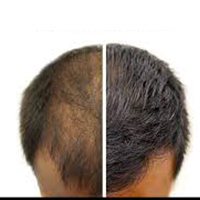 HAIR TRANSPLANT