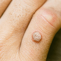WARTS