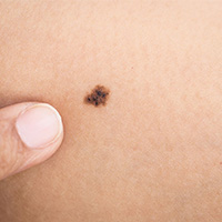 MOLES