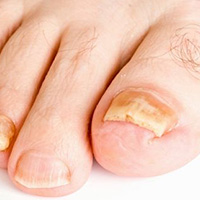 NAIL INFECTIONS
