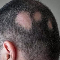 PATCHY HAIRLOSS/ALOPECIA ARREATA