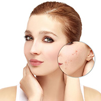 ACNE SCARS