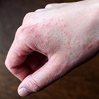 DERMATITIS