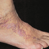 LICHEN PLANUS