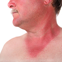SUN DAMAGE/ SENSITIVE SKIN