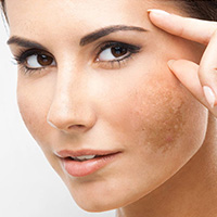 HYPERPIGMENTATION AND MELASMA