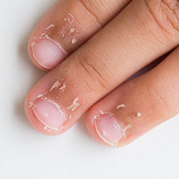 ECZEMA/DRY SKIN
