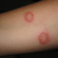 FUNGAL INFECTIONS