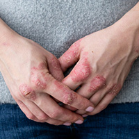 PSORIASIS